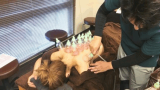 cupping_01